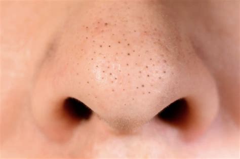 Blackheads On Face