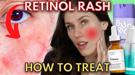 Do You Have A Retinol Rash Or Are You Experiencing Retinization? - YouTube