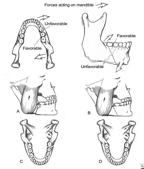 ORAL & MAXILLO-FACIAL SURGERY: Mandibular Angle Fractures