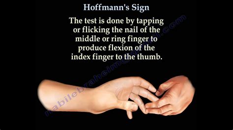 Hoffmann's Sign - Everything You Need To Know - Dr. Nabil Ebraheim - YouTube