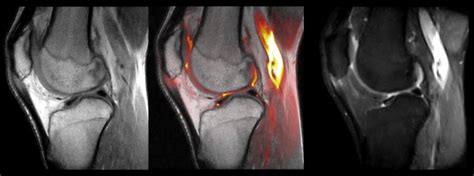 A Thermographic Evaluation of Patellar Tendon Partial Tear | coachingultrasound