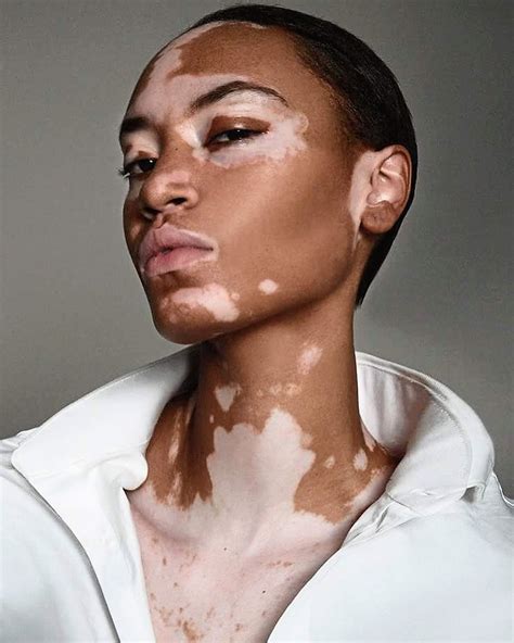 How To Treat Vitiligo? - Gentedelasafor.net