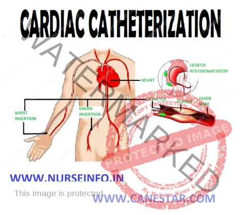 CARDIAC CATHETERIZATION - Nurse Info