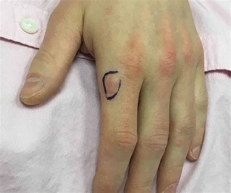 Firm Cutaneous Nodule on the Dorsal Hand: A Case Report on Fibroblastic ...