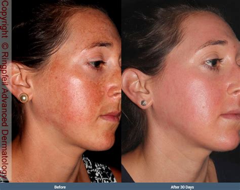 Melasma Before After