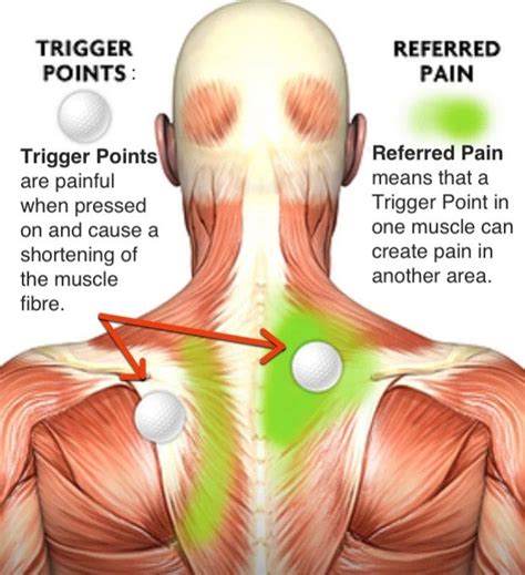 Everything You Need to Know About Trigger Point Massage Therapy