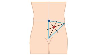 Stoma surgery - Coloplast