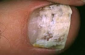 white superficial onychomycosis | Current Health Advice, Health Blog Articles and Tips