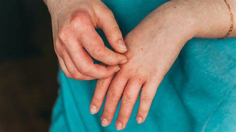 7 Types of Eczema: Symptoms, Causes, and Pictures