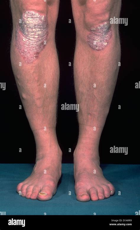 Plaque psoriasis hi-res stock photography and images - Alamy