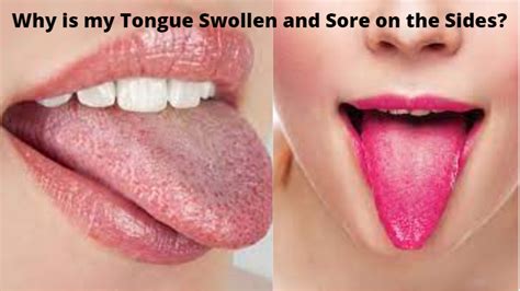 11 Swollen Tongue Causes What Does A Swollen Tongue Mean? | lupon.gov.ph