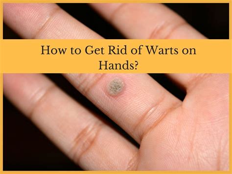 How to Get Rid of Warts on Hands? Causes and Removal Options - https://healthyskinadviser.com ...