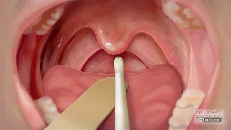 Oropharyngeal Swab Procedure