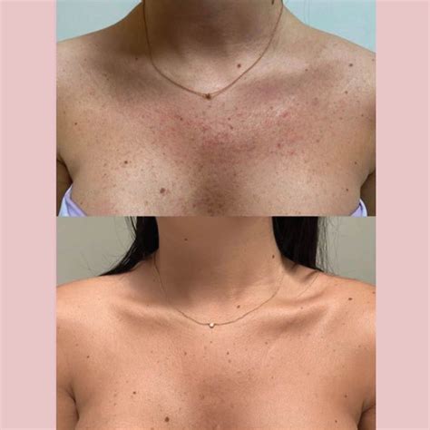 Top 98+ Background Images Bumpy Skin Keratosis Pilaris Before And After Amlactin Sharp