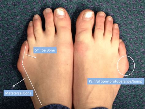 Bunionette Deformity Treatment - London Foot & Ankle Clinic