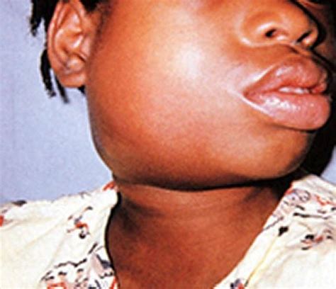 Submandibular Gland Swelling In Children