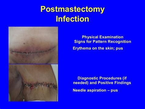 Mastectomy Morbidities: Prevention, Detection, and Treatment (Focus: