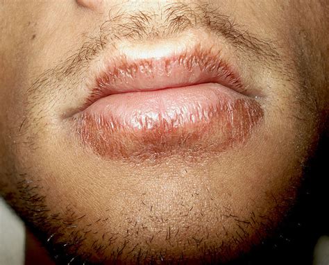 How To Avoid Dry Lips - Hirebother13