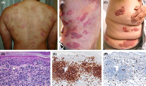 T Cell Lymphoma Skin Cancer