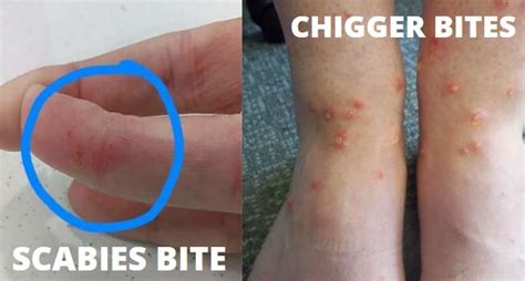 The Complete Guide To Chiggers Vs Scabies! | Y-L-P-C