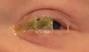 Excessive Eye Boogers: Causes, Types and Treatment – EYExan.com