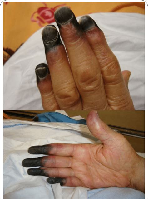 (a,b): Acrocyanosis of all fingers, evolved into distal necrosis on... | Download Scientific Diagram