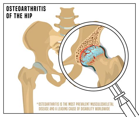 hip-osteoarthritis-physio | Simply Align Rehab