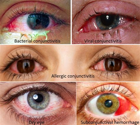 Red Eyeball Causes