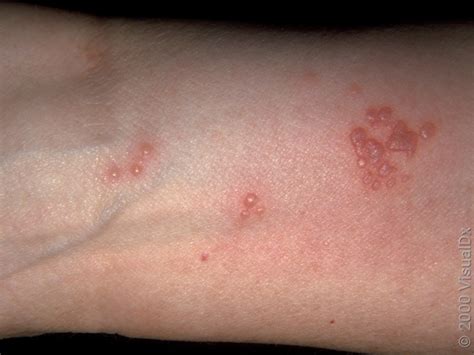 What Does a Shingles Rash Look Like? Stages in Pictures - GoodRx