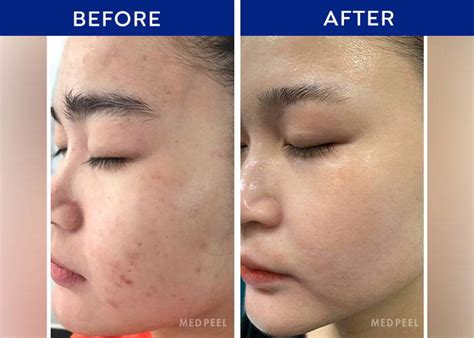 chemical skin peel before and after– Medpeel