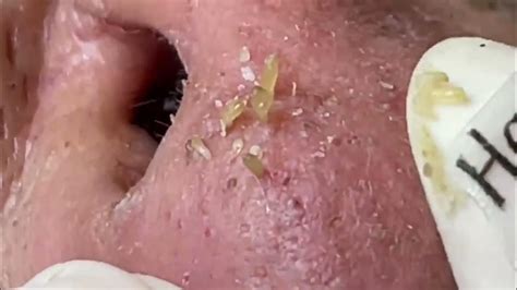 Nose Blackheads Removal with Hari's Beauty - 2022 - YouTube