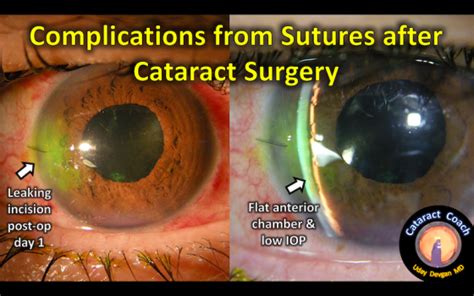 Suture Complications after Cataract Surgery – Cataract Coach