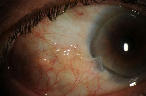 Moran CORE | Limbal Stem Cell Deficiency Image Report