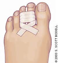 Toe Fractures Treatment | Foot Doctor Southlake, Keller, Flower Mound ...