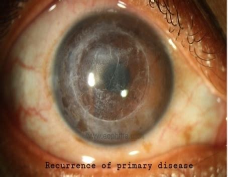 Complications of Penetrating Keratoplasty