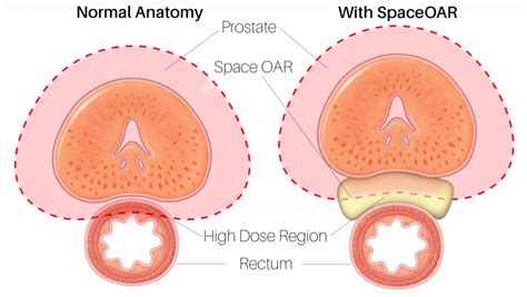 Prostate Cancer Treatment Side Effects Aren't Side Issues When They ...