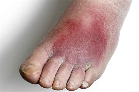 Bacterial Infection On Foot Cheap Sale | emergencydentistry.com