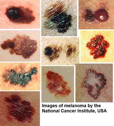 Healthy Horizons! : Warning Signs of Melanoma, The Most Deadly Form Of Skin Cancer