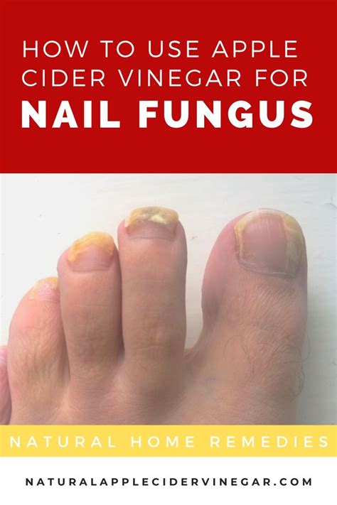 How to Use Apple Cider Vinegar for Nail Fungus - All Natural Home ...