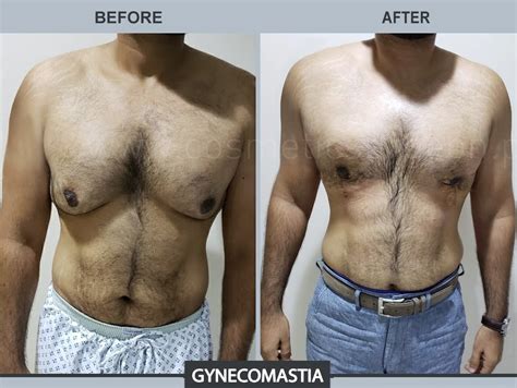 Gynecomsatia Before & After - Cosmetic Surgeon