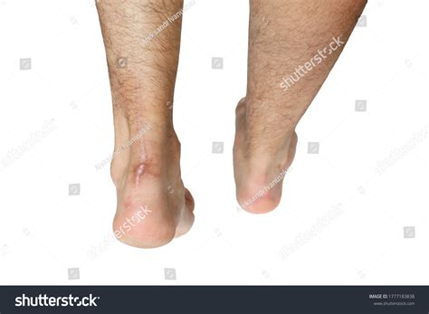 Operation Scar Achilles Tendon Rupture White Stock Photo 1777183838 ...