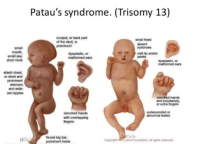 Errors in Antenatal Genetic Diagnosis and Wrongful Therapeut