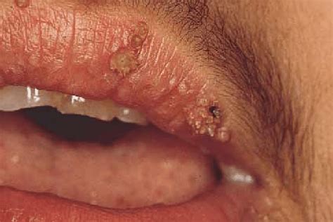 Hpv Warts Lips Pictures | Lipstutorial.org