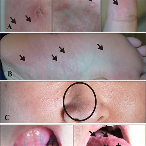 Clinical images of the 21-year-old patient. Multiple punctate... | Download Scientific Diagram