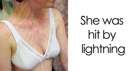 Lichtenberg Scars — Nature’s Tattoo You Don’t Want To Have | Bored Panda