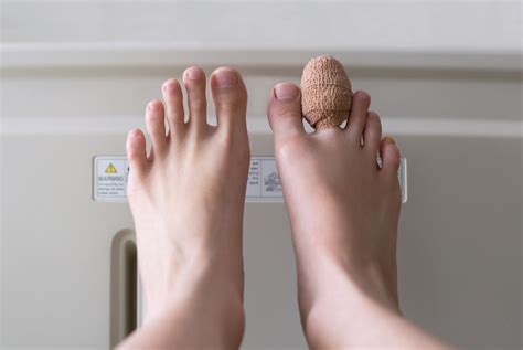 Everything You Need to Know About Second Toe Shortening Surgery