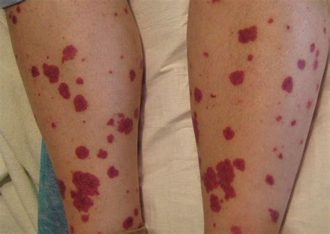 Lupus Rash: What It Is and How to Treat It - GoodRx