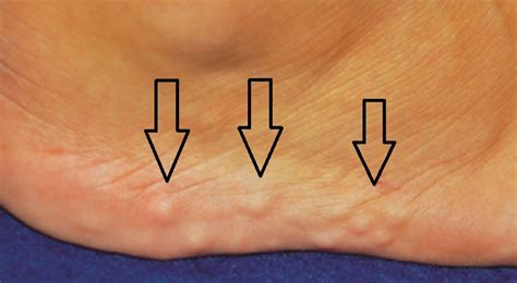 Piezogenic Pedal Papules - Ankle, Foot and Orthotic Centre