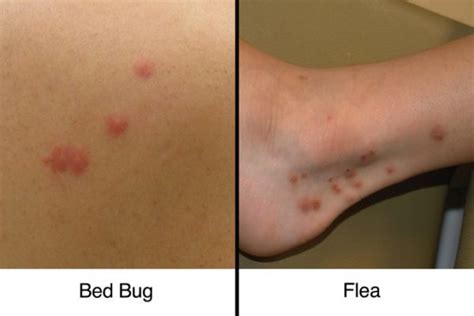 Bed Bug Bites Vs Flea Bites – Quickly Tell the Difference