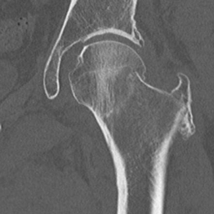 Garden classification of hip fractures | Radiology Reference Article | Radiopaedia.org
